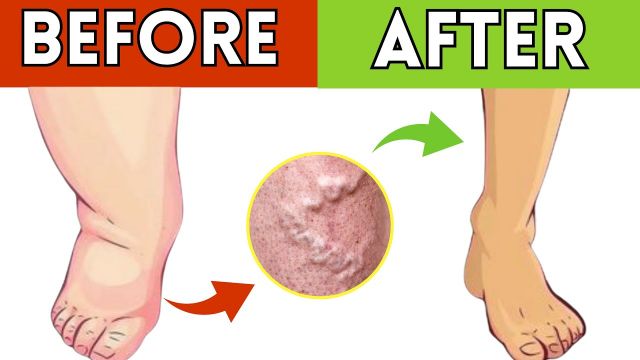 **Top 5 Drinks to Boost Leg Circulation & Blood Flow Instantly!